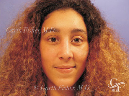 Photo of Patient 16 After Primary Rhinoplasty
