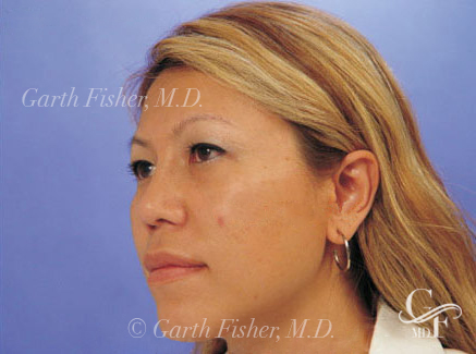 Photo of Patient 19 After Primary Rhinoplasty