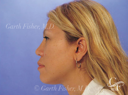 Photo of Patient 19 After Primary Rhinoplasty