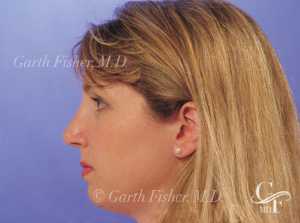 Photo of Patient 21 After Primary Rhinoplasty