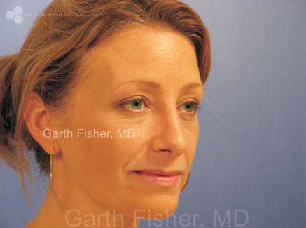 Photo of Patient 23 After Primary Rhinoplasty