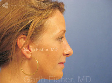 Photo of Patient 23 After Primary Rhinoplasty