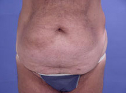 Photo of Patient 02 Before Tummy Tuck